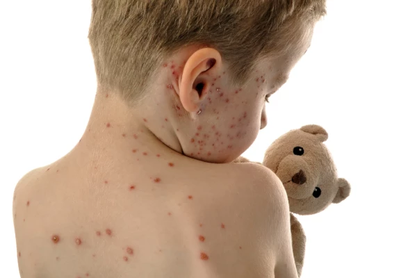 Image for article titled Don't Let Measles, Mumps and Rubella into your child's world